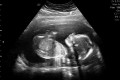 Unsettled and Inconsistent Law: Fetal Rights and Personhood